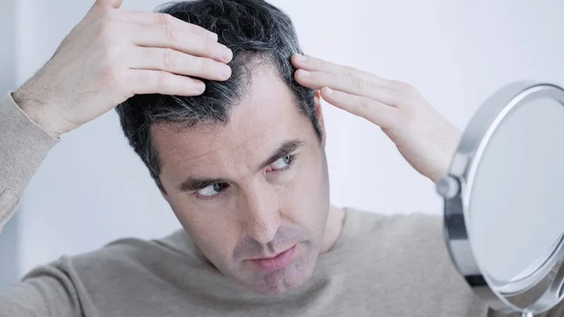 10 Cele Mai Bune Tratamente Pentru Subțierea Părului La Bărbați