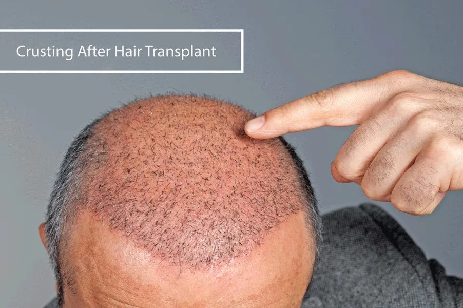 Când Și Cum Pot Îndepărta Crusta După Transplantul de Păr?