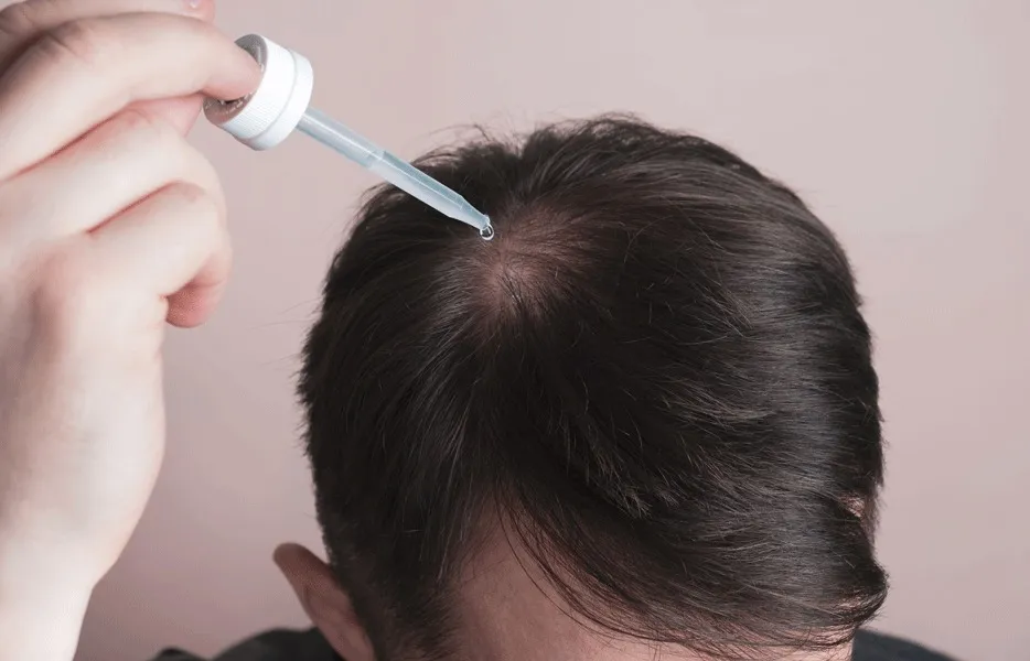 Trebuie Să Luați Minoxidil După Transplantul de Păr?