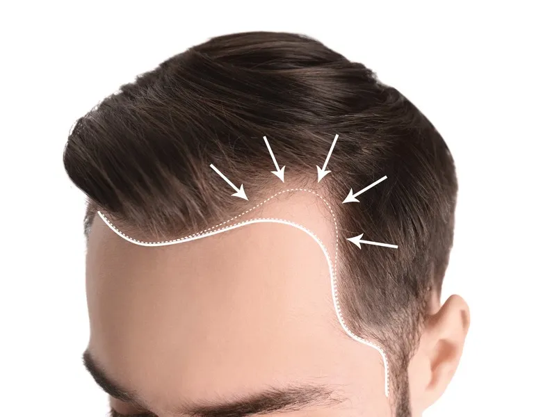 Linia Părului: De Ce Este Important?